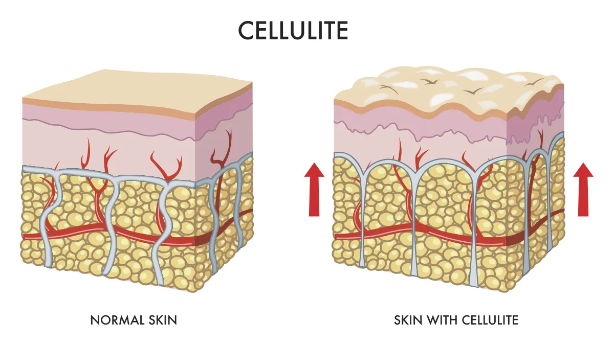 a depiction of skin structure with and without cellulite